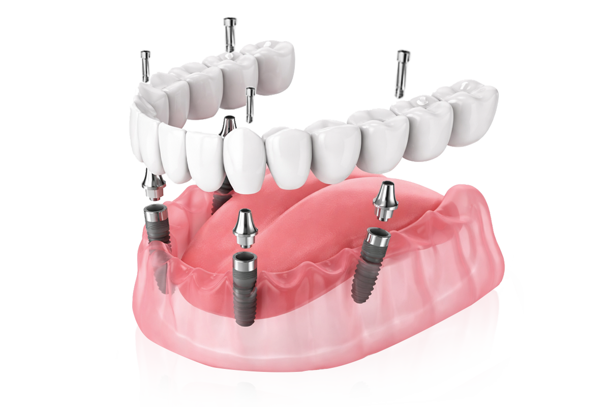 전체 임플란트 시술 이미지