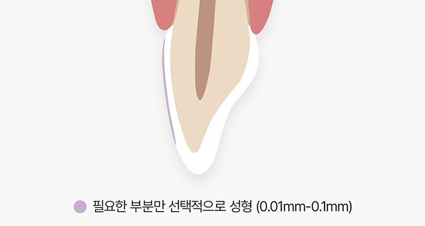 미세삭제 라미네이트