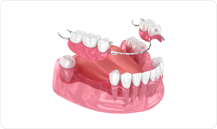 부분 틀니(Partial Denture)
