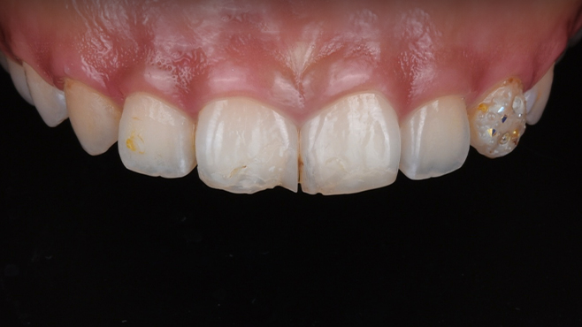 앞니 라미네이트