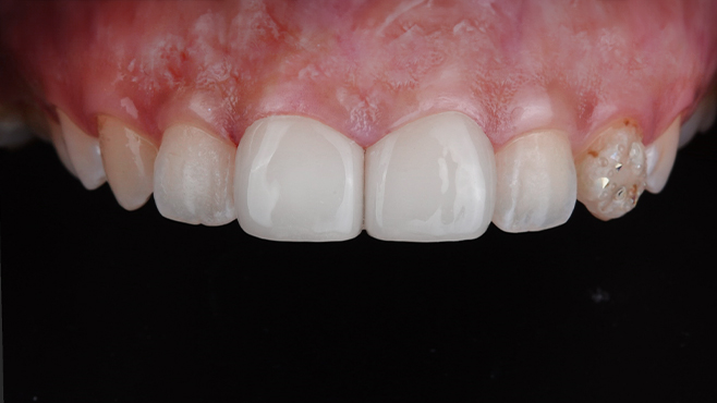 앞니 라미네이트