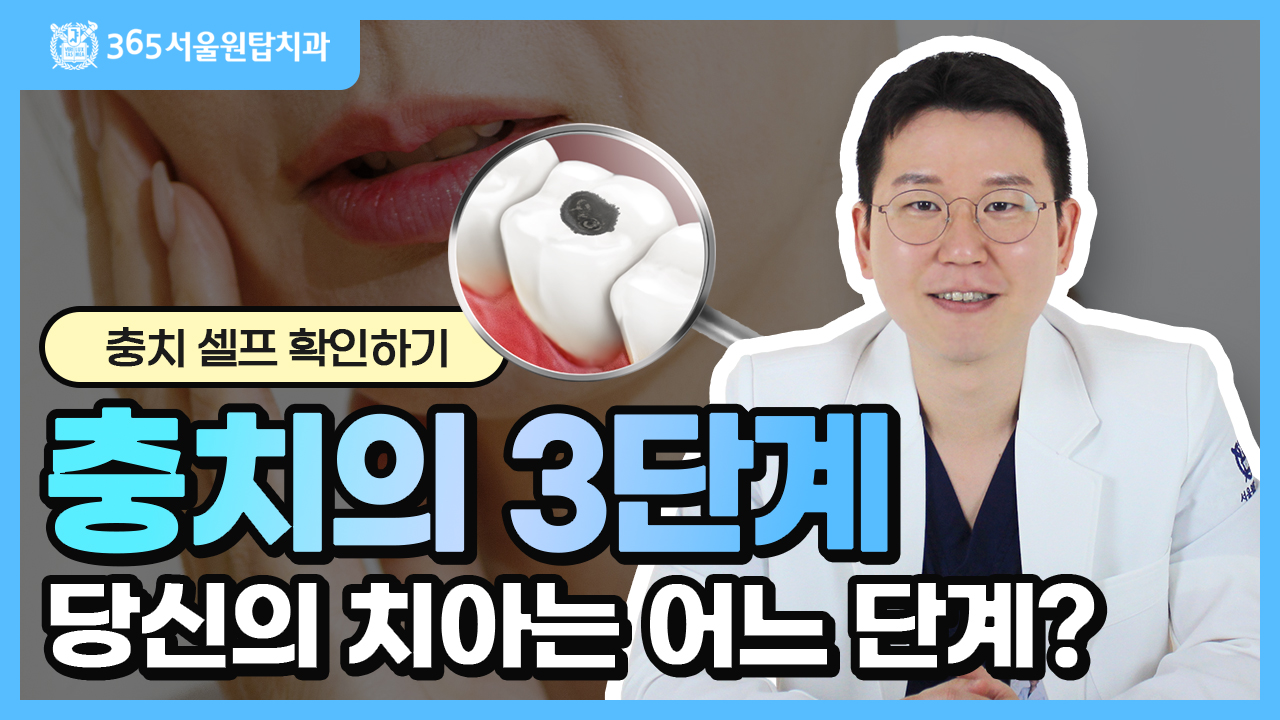 ⚠️ 당신의 충치는 지금 어느 단계? | 충치 자가 진단하기 | 충치 3단계와 치료법 알아보기!
