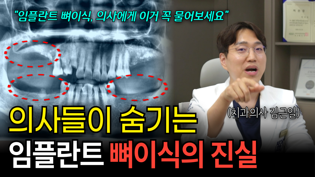  임플란트 뼈이식 오해와 진실, 잘못된 정보에 속지 마세요!