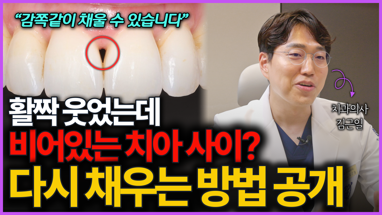 치아 사이 생긴 검은 틈, 하루 만에 해결하는 방법 공개합니다
