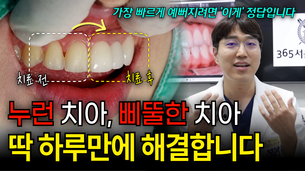  라미네이트 후기, 하루 만에 치아가 예뻐지고 인상이 바뀝니다