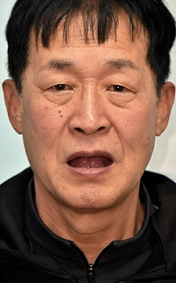 시니어 임플란트 치료 전