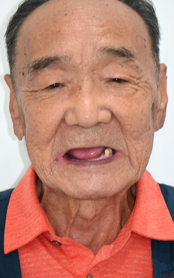 시니어 임플란트 치료 전