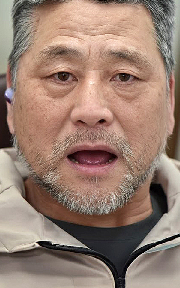 시니어 임플란트 치료 전