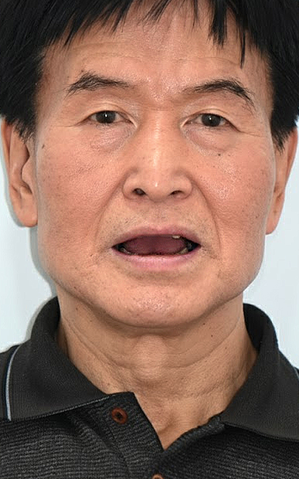 시니어 임플란트 치료 전