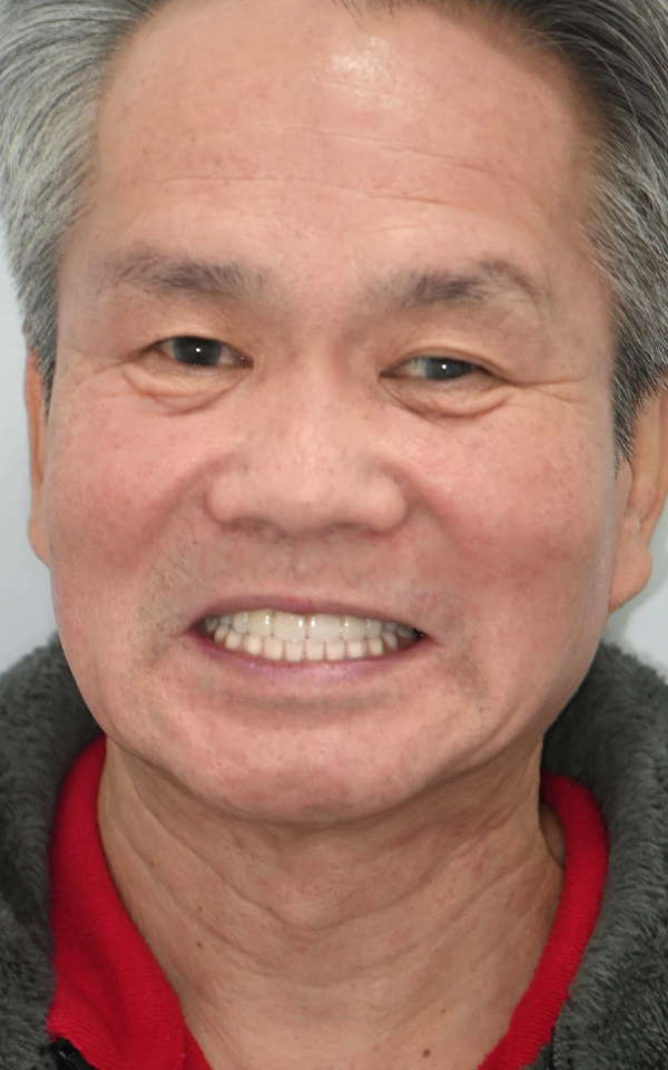 치아 전체 통증과 불편으로 내원하신 