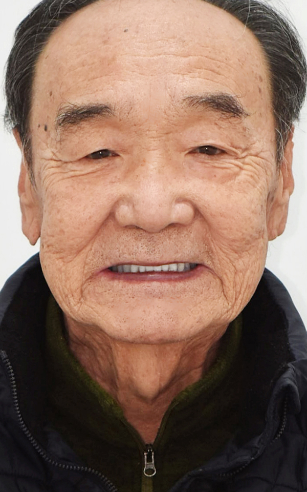 시니어 임플란트 치료 후