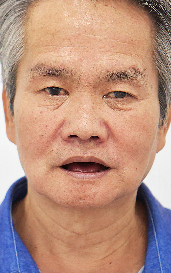 시니어 임플란트 치료 전